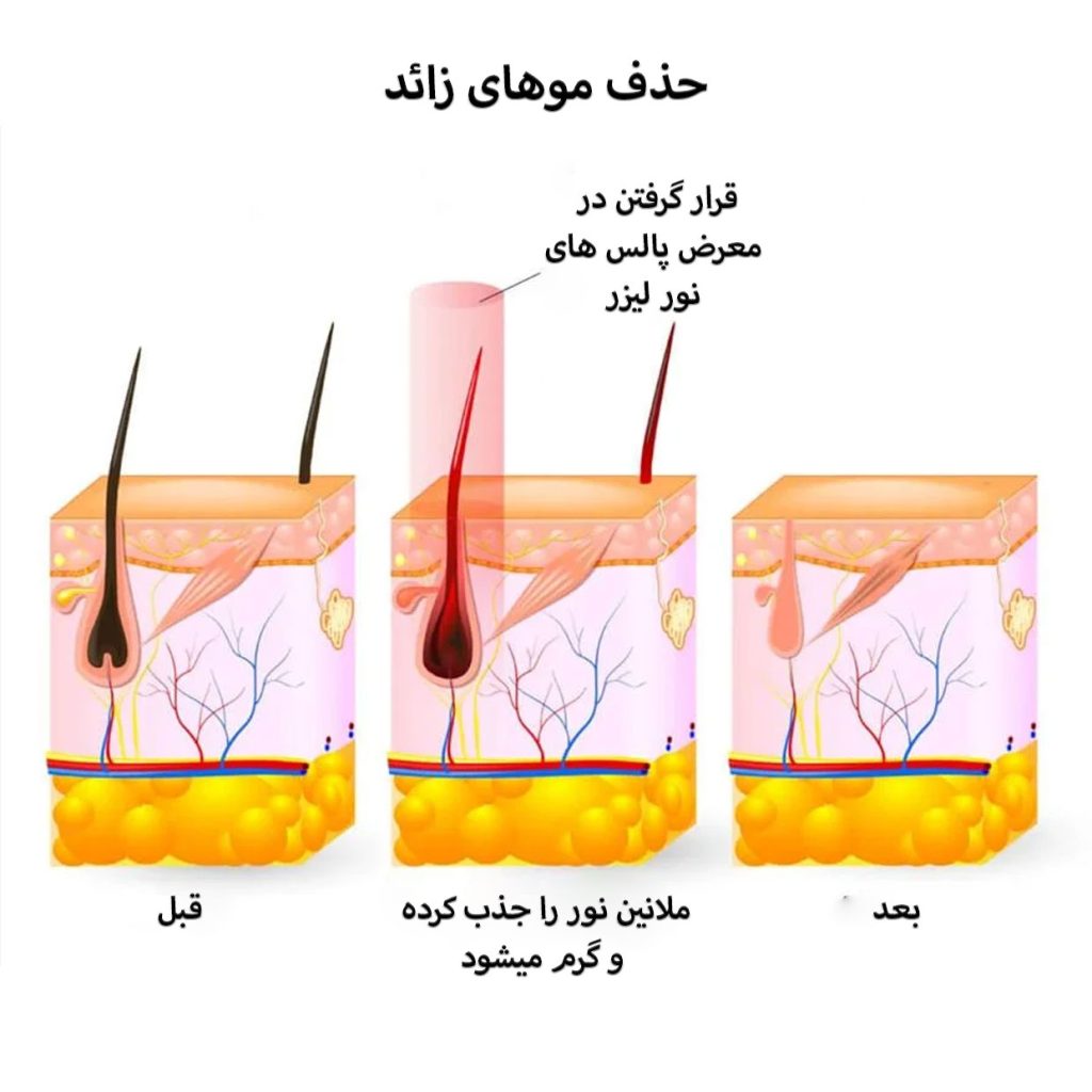 حذف-موهای-زائد-علم-نور-و-گرما